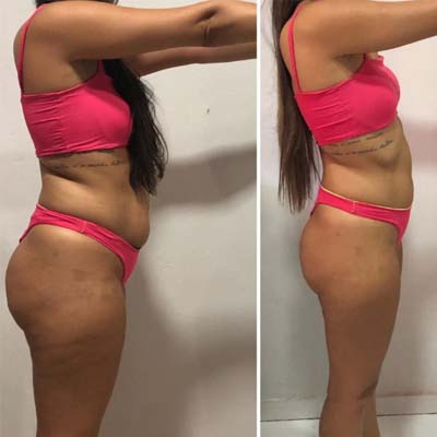 SEM BARRIGA ESTUFADA
